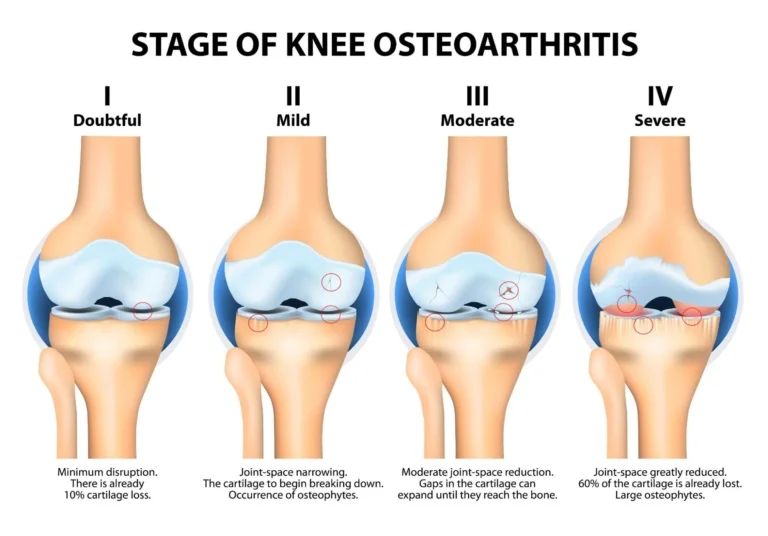 Fig: Stages of Knee Osteoarthritis